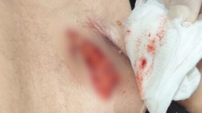 ÖZEL ECHOMAR HASTANESİ’NDE SAĞLIK SKANDALI İDDİASI BİSİKLET KAZASINDA YARALANAN 11